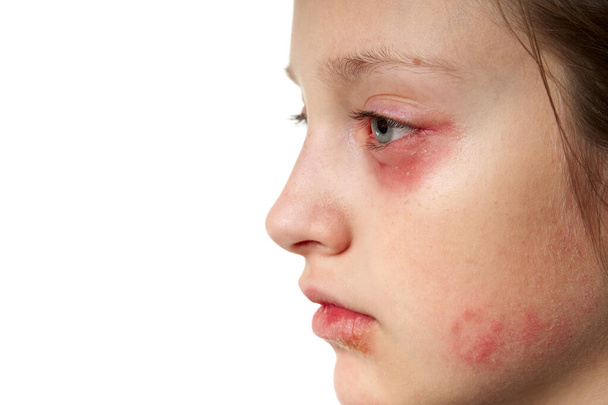 Αλλεργική αντίδραση, δερματικό εξάνθημα, κοντινό πορτραίτο προσώπου κοριτσιού. Ερυθρότητα και φλεγμονή του δέρματος στα μάτια και τα χείλη. Ασθένεια ανοσοποιητικού συστήματος. - Φωτογραφία, εικόνα