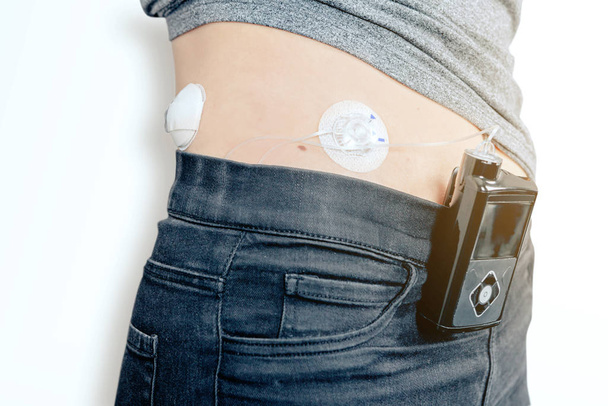 primer plano de una paciente diabética con bomba de insulina para perfusión conectada al vientre - dispositivo médico con tecnología de transmisión inalámbrica - concepto de atención sanitaria
 - Foto, Imagen