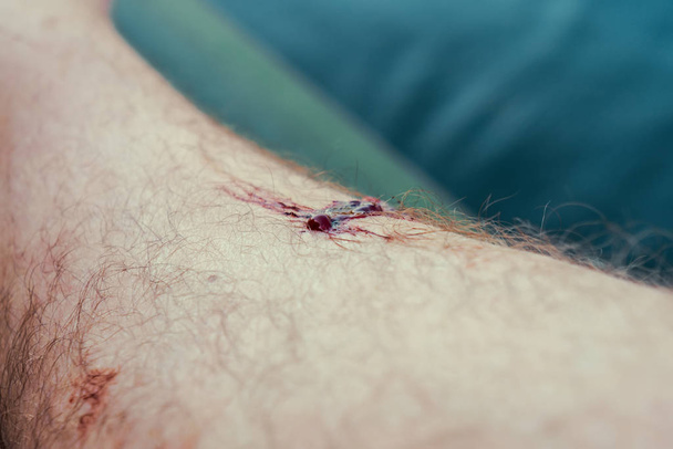 The bite of a leech. Bleeding wound. - Fotoğraf, Görsel