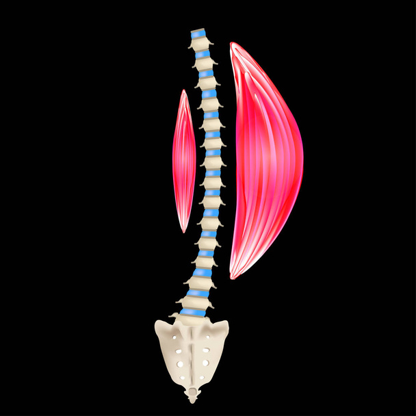 Escoliosis del lado izquierdo. Levoscoliosis. Músculos y columna vertebral. Curvatura espinal en escoliosis. Infografías. Ilustración vectorial
. - Vector, Imagen