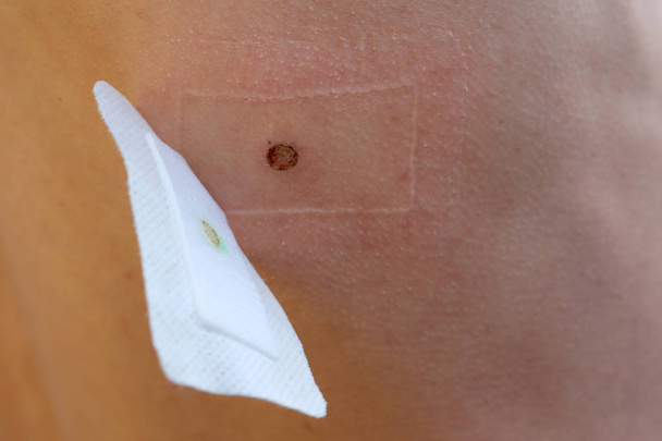 Selective focus. Scar immediately after laser removal of the mole. A wound from a mole on the back, a medical patch on the skin. trace after mole removal - Photo, Image