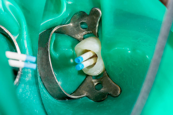 tratamiento endodóntico de los dientes de cerca. Limpieza de las raíces de
 - Foto, imagen
