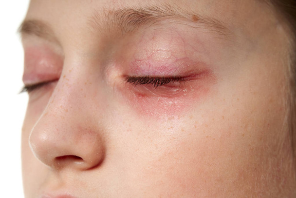 Reacción alérgica, erupción cutánea, retrato de la cara de una niña. Enrojecimiento e inflamación de la piel de los ojos y labios. Enfermedad del sistema inmunitario
. - Foto, imagen