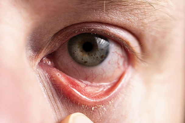 Rood oog met suppuratie op wimpers close-up - Foto, afbeelding
