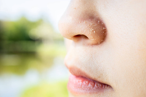 Mujer joven alérgica tiene eccema nariz seca en la temporada de invierno, femal
 - Foto, Imagen