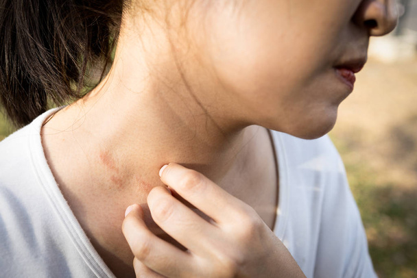Szoros nő kézvakarás bőr viszkető allergia miatt, allergiás bőrkiütés dermatitis ekcéma bőr vagy gombás, a nők viszketnek a verejték allergia, atópiás dermatitis vörös kiütés a nyakon - Fotó, kép