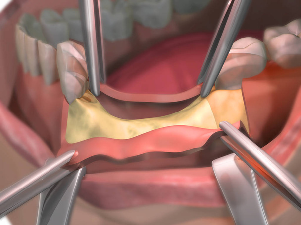 Knochenschwund nach der Zahnentfernung. geöffnetes Zahnfleisch vor der Operation mit Knochentransplantat. Knochenregeneration. Schritt der Öffnung des Zahnfleisches. 3D-Illustration. - Foto, Bild