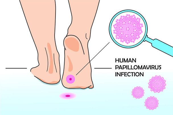 DNA virüsünün tıbbi bir örneği. İnsan papillomovirüsü. Ayaklar yere basıyor ve büyüteç altında HPV virüsü modeli. - Vektör, Görsel