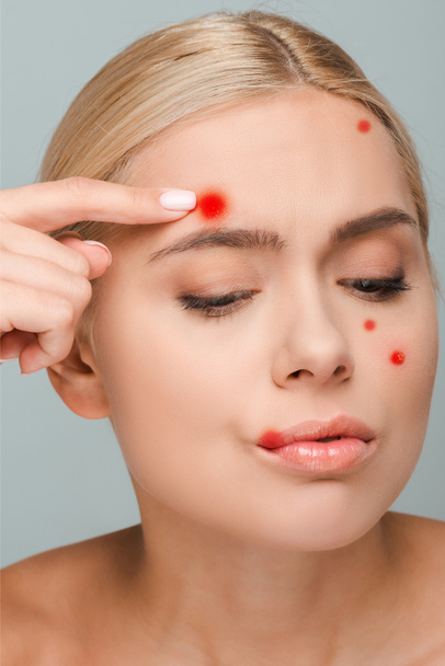 displeased and naked girl touching face with red pimples isolated on grey  - Photo, Image