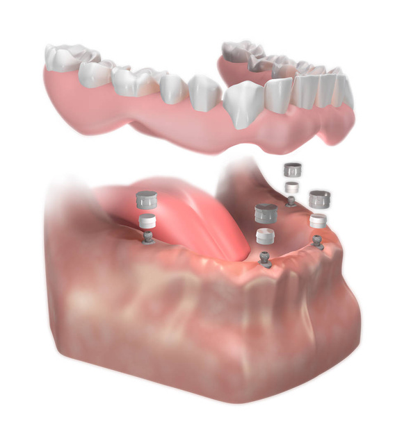 Instalação Ball Abutment. Implante inferior suportado Dentura removível completa. Ilustração 3D
. - Foto, Imagem