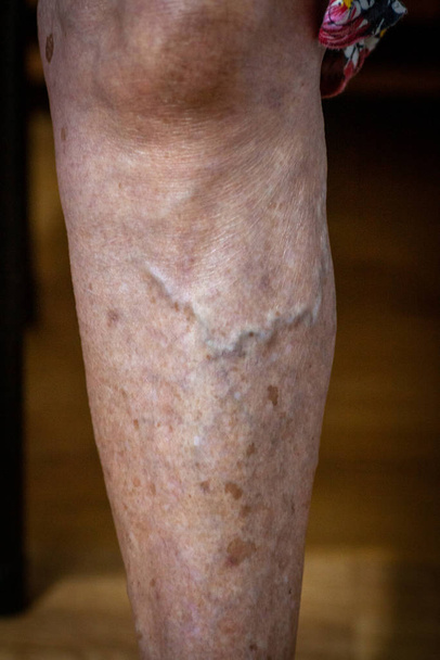 closeup feet of old an suffering from leprosy - Photo, Image