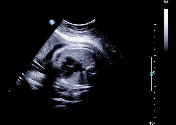 Ultraschall des Fötus in der Schwangerschaft im dritten Monat - Foto, Bild