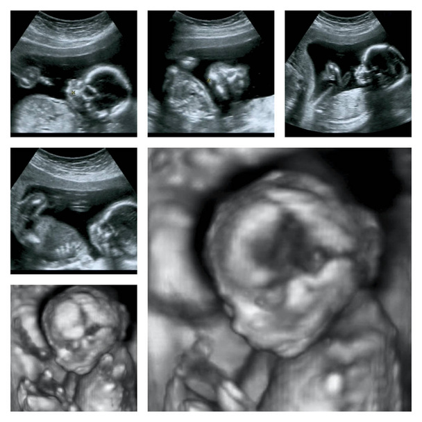 Kolaż 3d USG płodu w czwartym miesiącu ciąży - Zdjęcie, obraz