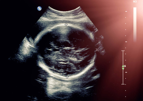 Υπερηχογράφημα του εμβρύου κατά τον τρίτο μήνα της εγκυμοσύνης - Φωτογραφία, εικόνα