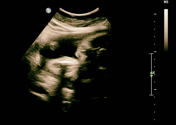USG płodu w trzecim miesiącu ciąży - Zdjęcie, obraz