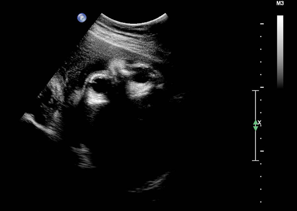 USG płodu w trzecim miesiącu ciąży - Zdjęcie, obraz