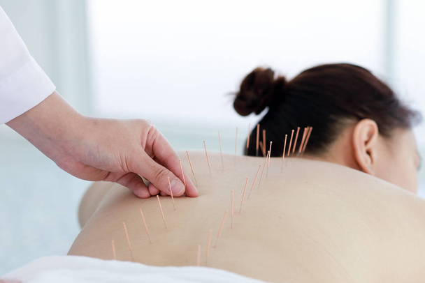 hand of doctor performing acupuncture therapy . Asian female und - Foto, Bild