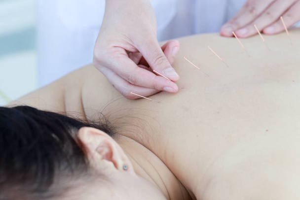 hand of doctor performing acupuncture therapy . Asian female und - Foto, Bild