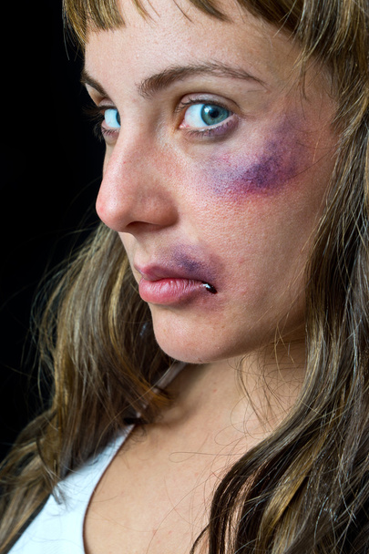 woman with bruises - Fotoğraf, Görsel