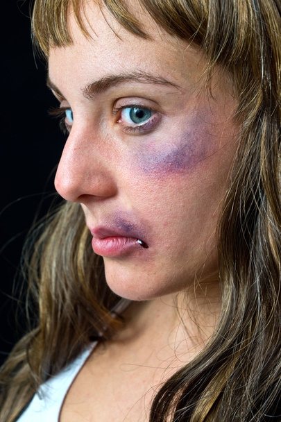 woman with bruises - Foto, Bild