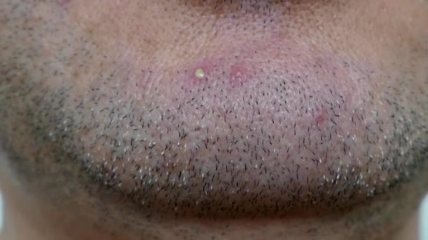 een ontstoken acne op een mannelijk gezicht, een ontstoken acne in het menselijke kaakgedeelte, acne probleem bij mensen, - Video