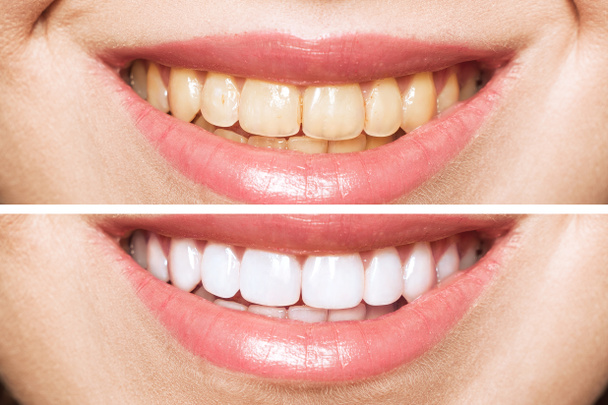 žena zuby před a po bělení. Přes bílé pozadí. Pacient na zubní klinice. Obrázek symbolizuje ústní péči, stomatologii - Fotografie, Obrázek