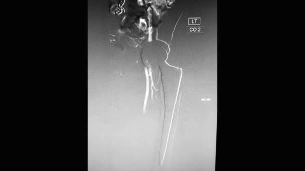 Angiografia lewej tętnicy udowej z protezą lewego biodra - Materiał filmowy, wideo