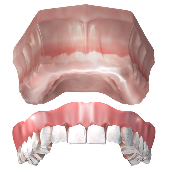 取り外し可能な上部入れ歯は歯のない上部歯茎に入ります。完全な入れ歯、歯のプレート。3Dイラスト - 写真・画像