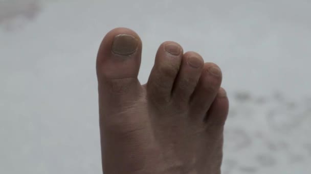 callo y hongos en los dedos de los pies, endurecimiento de la piel
, - Metraje, vídeo