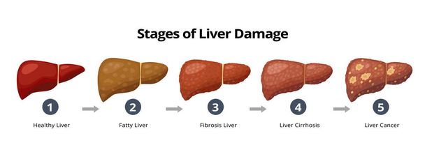 Stages of liver damage from healthy, fatty liver, fibrosis, cirrhosis to liver cancer. Medical infographic, liver diseases icons in flat design isolated on white background. - ベクター画像