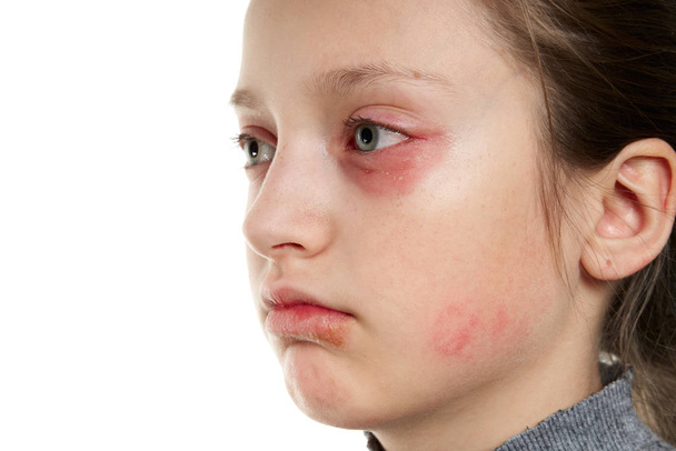 アレルギー反応、皮膚発疹、少女の顔の近いビューの肖像画。目や唇の皮膚の発赤や炎症.免疫系疾患. - 写真・画像