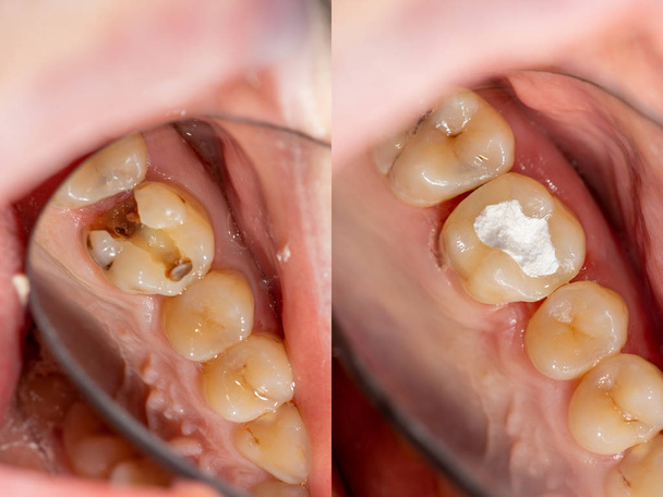 эндодонтическое лечение зубов крупным планом. Очистка корней
 - Фото, изображение