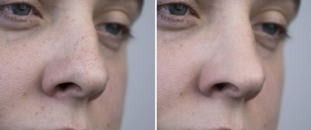 Mustia pisteitä, tukkeutuneita huokosia miehen nenässä. Potilas kosmetologin vastaanotolla. Ennen ja jälkeen kasvojen puhdistus
 - Valokuva, kuva