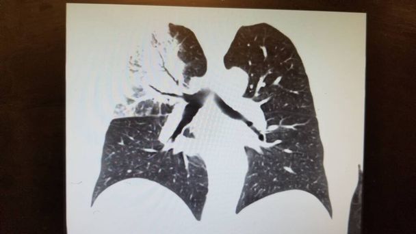 Μυκόπλασμα πνευμονία στο στήθος Ct σάρωση του θώρακα - Φωτογραφία, εικόνα