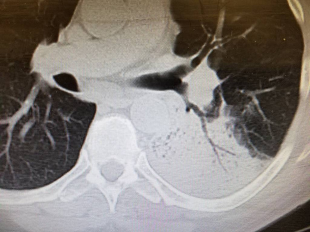左下葉肺炎で空気気管支グラム - 写真・画像