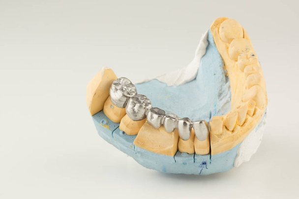Τεχνητό δόντι κορώνα - Φωτογραφία, εικόνα