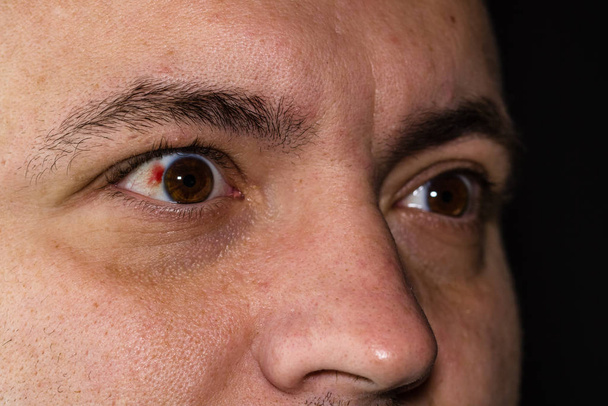 Lesión ocular, hombre joven con un vaso sanguíneo reventado en el ojo, fatiga, p
 - Foto, Imagen
