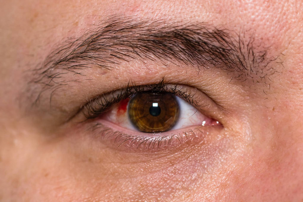Οφθαλμικός τραυματισμός, νεαρός άνδρας με σπασμένο αιμοφόρο αγγείο στο μάτι, κόπωση - Φωτογραφία, εικόνα