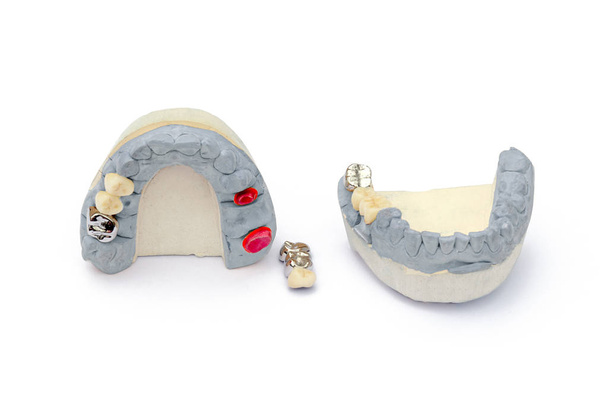 kunsttanden van metaal en keramiek. concept van het vervangen van ontbrekende tanden. tandprotheses - Foto, afbeelding