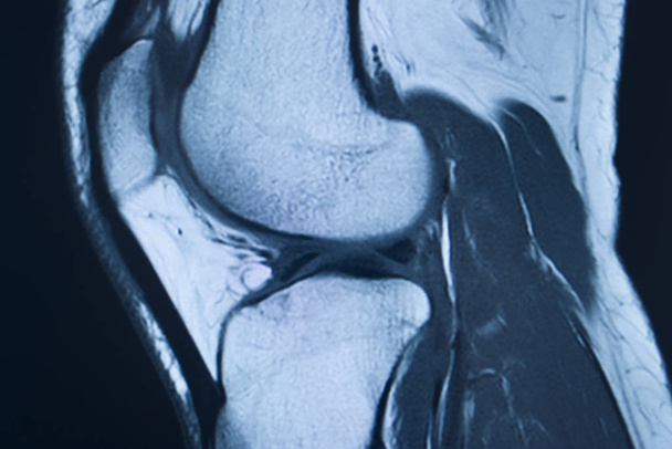 Lesión de rodilla mri mcl lágrima
 - Foto, imagen