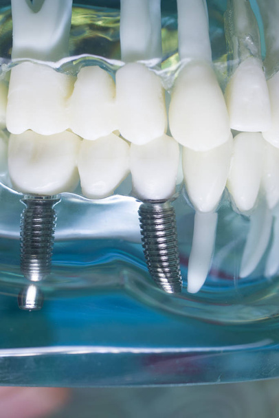 Dentista dentes implante modelo dentário
 - Foto, Imagem