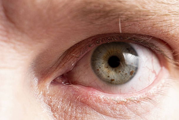 Sore eye with suppuration on eyelashes closeup - Photo, Image