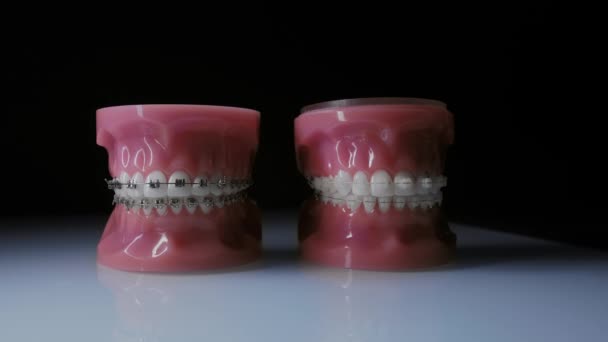 Detailní záběr zubů s kovovými a průhlednými rovnátky. Porovnání různých závorek - Záběry, video