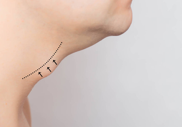 Marks in a man on an Adams apple, reduction and removal of the Adams apple in plastic surgery, thyroid cartilage. Chondrolaryngoplasty, copy space - 写真・画像