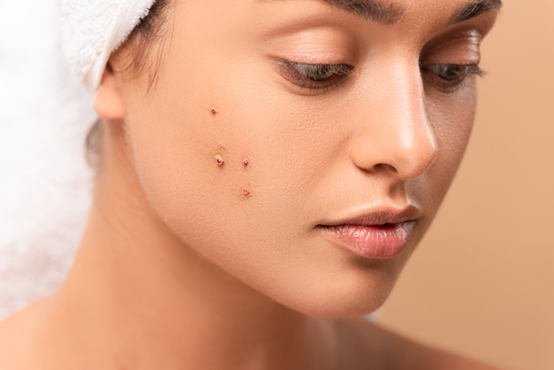 close up of young woman with pimples on face isolated on beige  - Zdjęcie, obraz