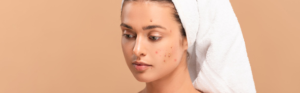 Panoramaaufnahme eines Mädchens mit Akne im Gesicht isoliert auf beige  - Foto, Bild