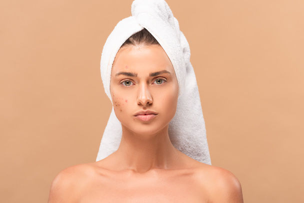 nude girl in towel with acne on face isolated on beige  - Photo, Image