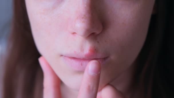 Herpes virus on human lips. Woman touching herpes sore on lip mouth, closeup. - Video, Çekim