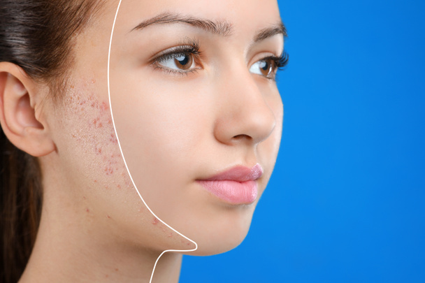 tiener meisje met acne probleem op blauwe achtergrond, close-up - Foto, afbeelding