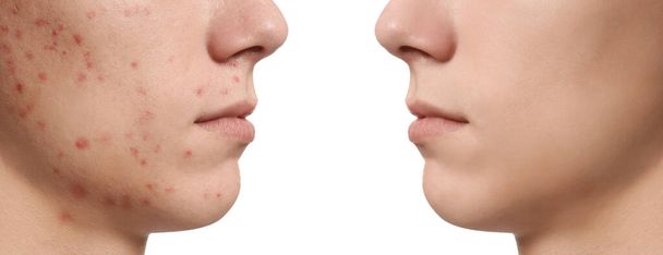Teenager before and after acne treatment on white background, closeup  - 写真・画像